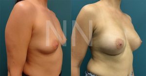 breast-augmentation2