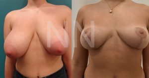 breast-reduction7