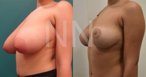 breast-reduction8