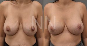 Secondary Breast Implant Surgery Case 9 1