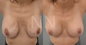 Secondary Breast Implant Surgery Case 9 2