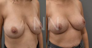Secondary Breast Implant Surgery Case 9 3