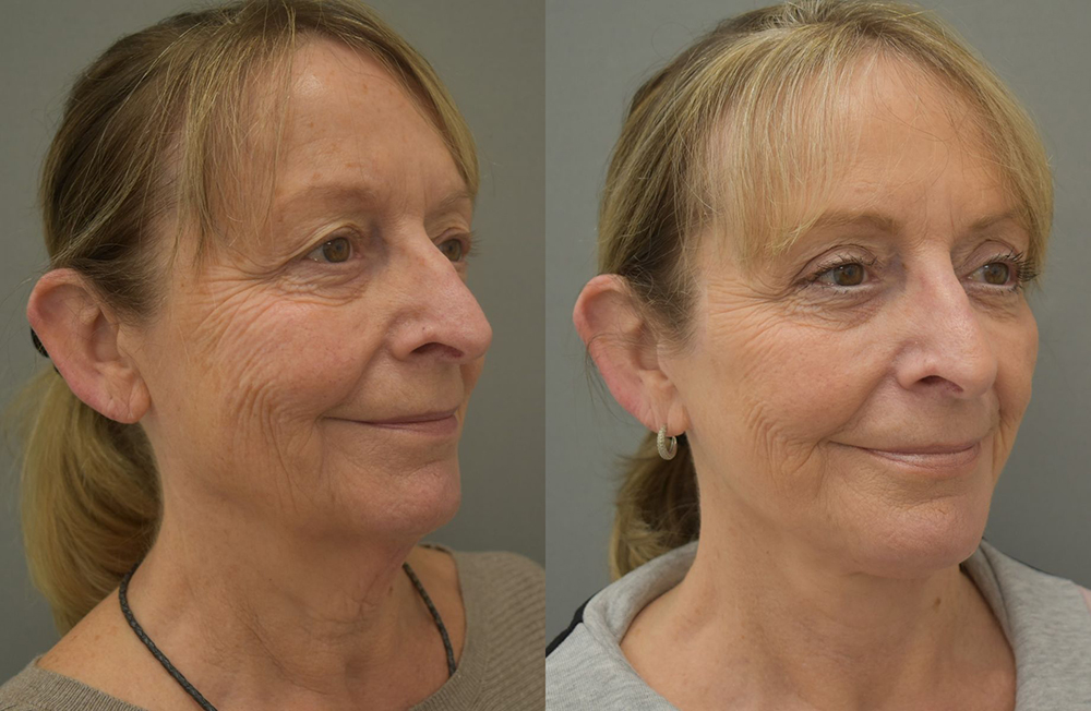 Before and after patient results 2