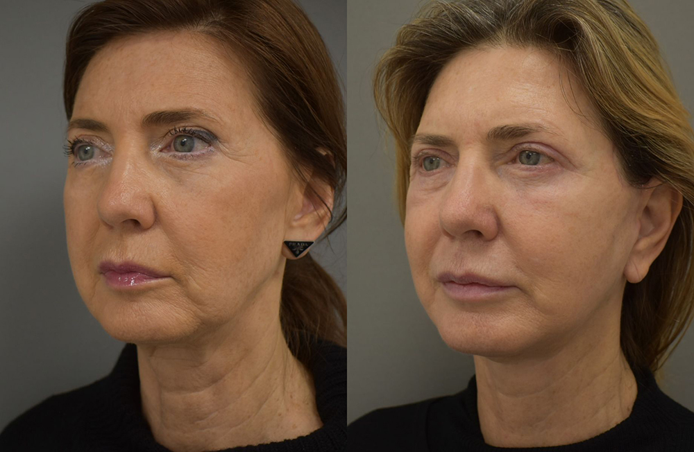 Before and after patient results 3