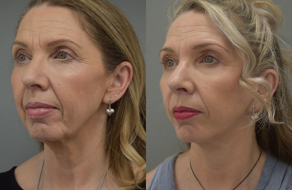 Before and after patient results 1